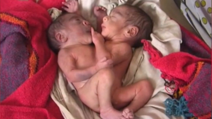 The parents were in for a shock as the mother did not undergo the ultrasound procedure during the pregnancy. (Photo: Screen grab) The parents were in for a shock as the mother did not undergo the ultrasound procedure during the pregnancy. (Photo: Screen grab)
